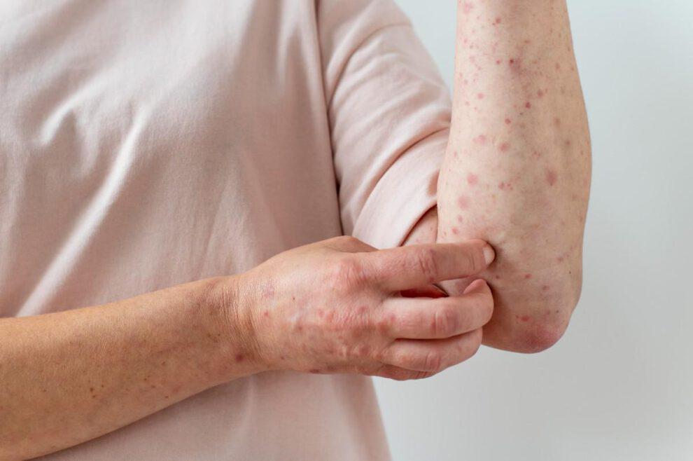 Incremento de casos de varicela en Potosí genera preocupación entre autoridades sanitarias