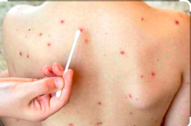 Incremento de casos de varicela en Potosí genera alerta