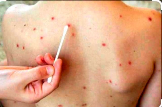 Aumento de varicela genera preocupación en Potosí
